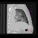Lung contusion: CT - Computed tomography